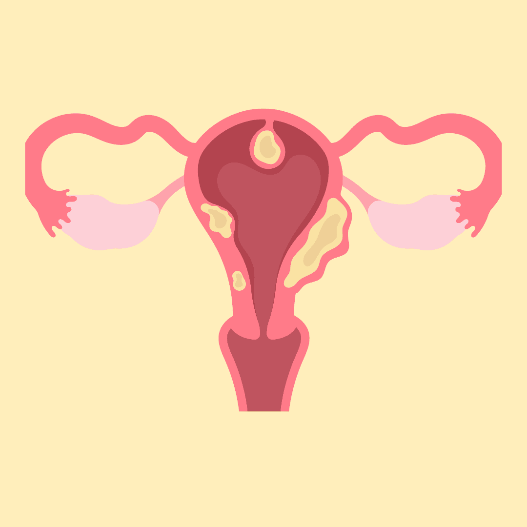 a graphic of Fibroids with a beige background.